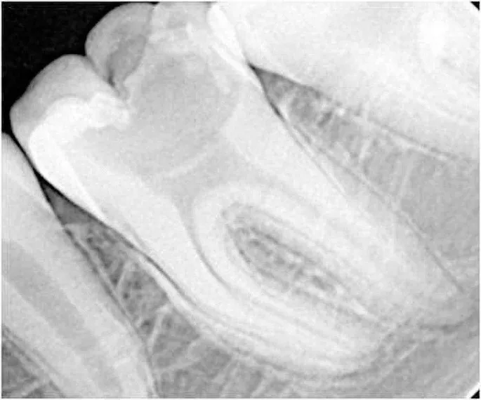 Management of Deep Carious Lesions: A Cross-Sectional Study among Saudi Dentists