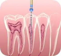 Postoperative Pain Following Root Canal Treatment in Riyadh Elm University Hospitals: A Prospective Study